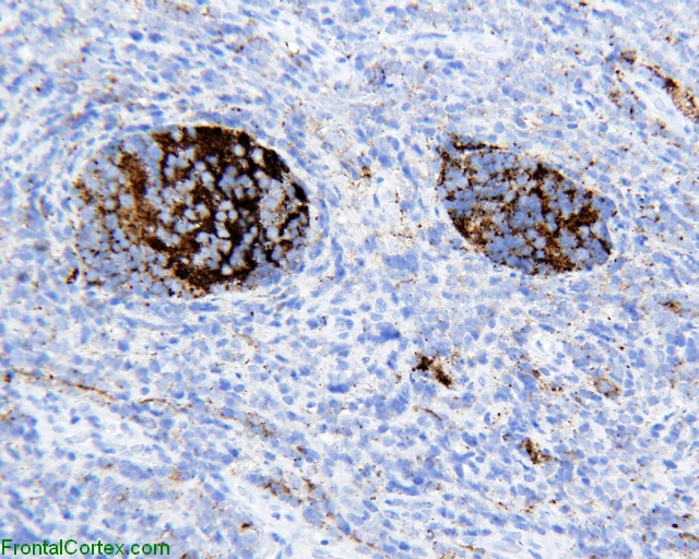 Desmoplastic medulloblastoma, Synaptophysin immunohistochemical staining x 100